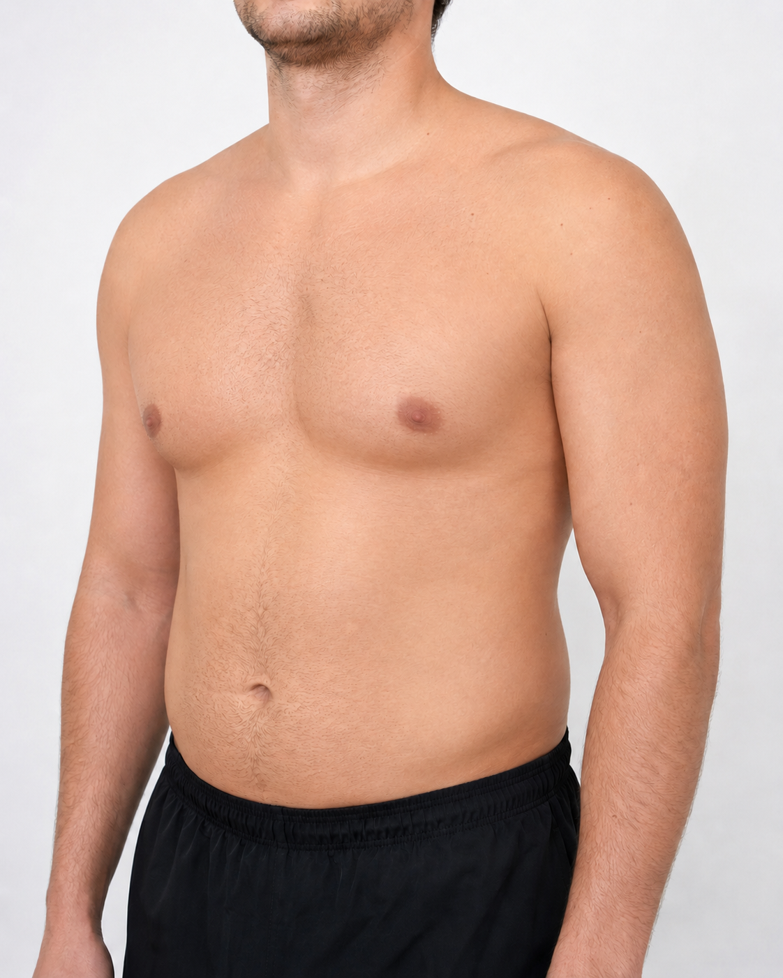 After gynecomastia chest contouring result